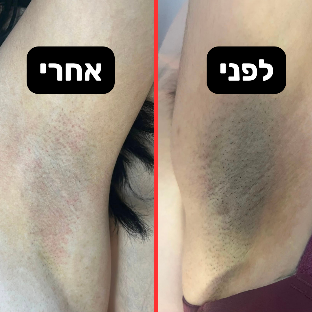 תוצאה לפני ואחרי - בית השחי