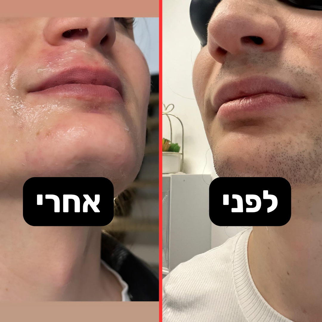 תוצאה לפני ואחרי - אזור הסנטר